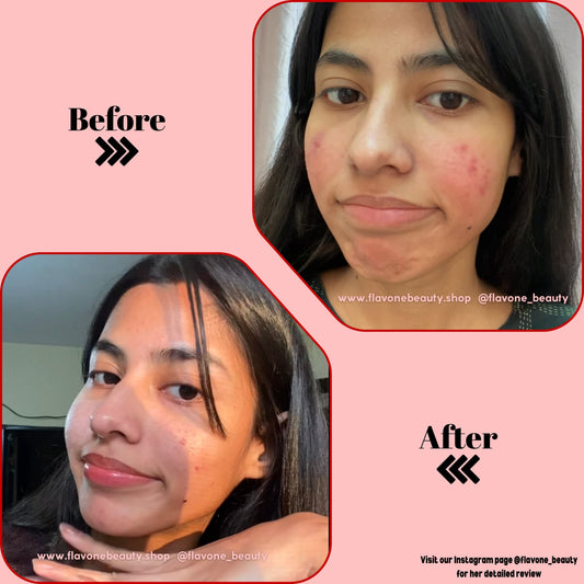 Brightening Cream❤ | Medicated, Steroid & Mercury Free